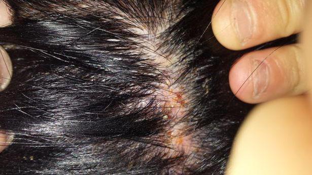 аллергия на краску для волос симптомы