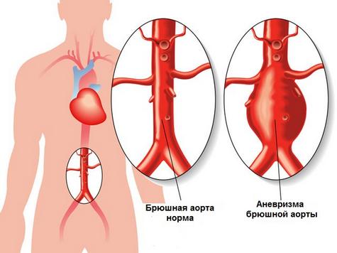 Аневризма аорты брюшной полости