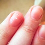 Белые пятна на ногтях при дефиците цинка