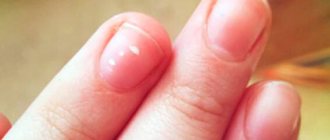 Белые пятна на ногтях при дефиците цинка
