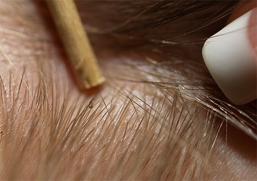 Если развести волосы пальцами или пинцетом, то можно хорошо рассмотреть гниды и самих вшей