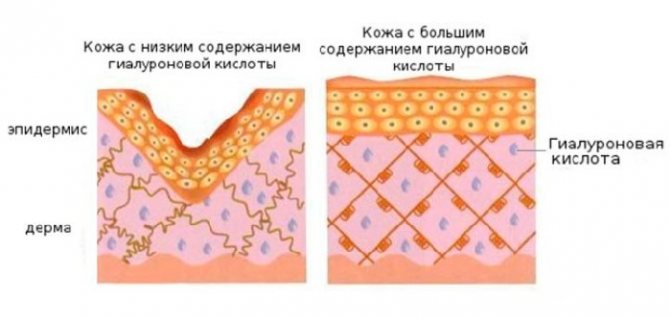 Гиалуроновая кислота в губы - фото до и после, сколько держится эффект, противопоказания
