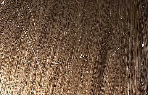 Гниды в волосах - характерный симптом заражения вшами