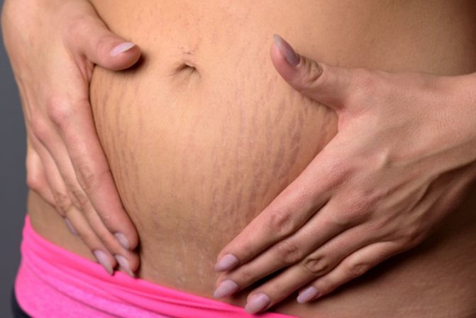 Как избавиться от растяжек на животе после родов