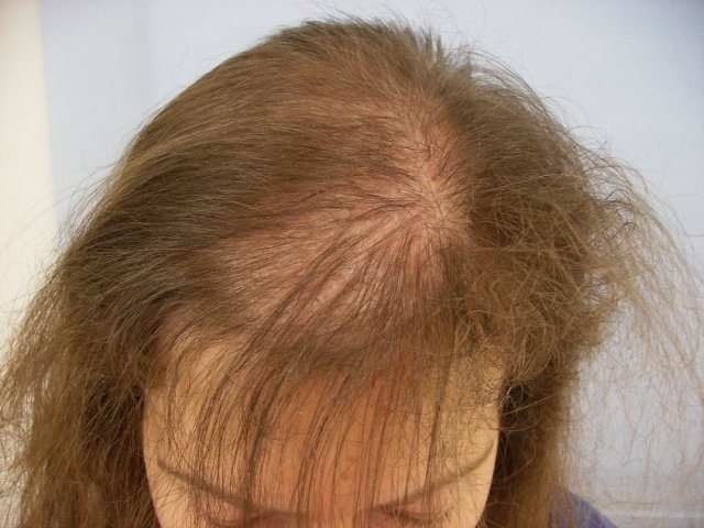 Как остановить выпадение волос у женщин при стрессе