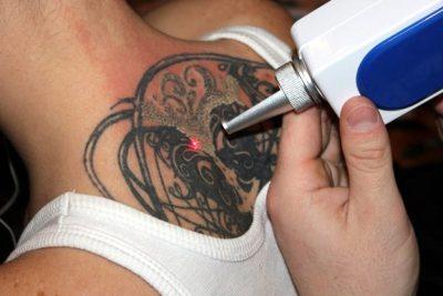 Как убрать татуировку
