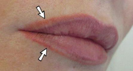 коррекция губ после татуажа