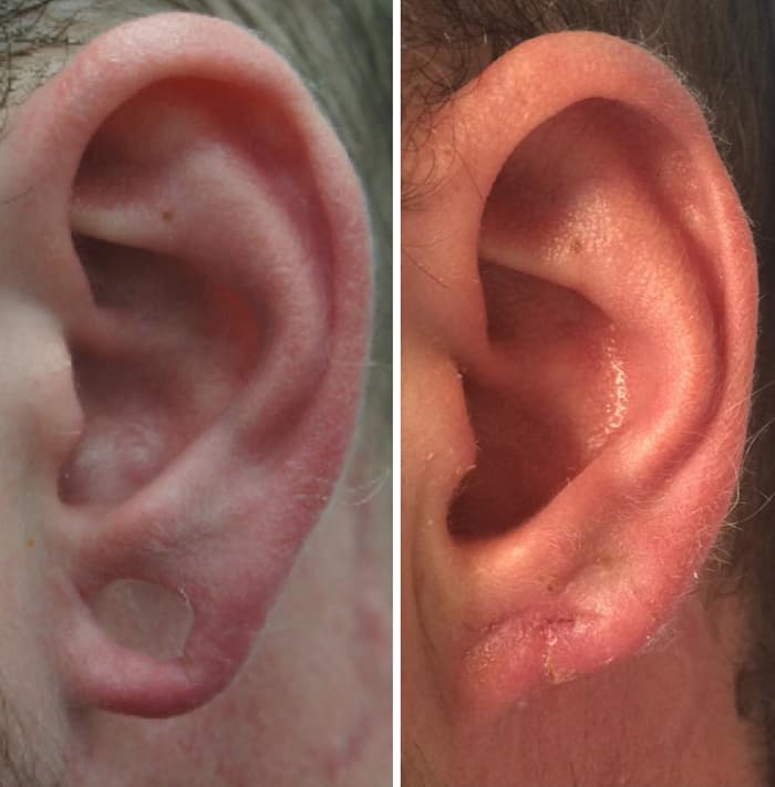коррекция мочек уха