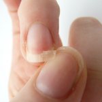 Ломки ногти часто свидетельствуют о несбалансированном питании.