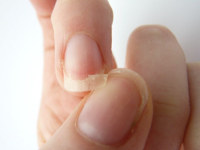 Ломки ногти часто свидетельствуют о несбалансированном питании.