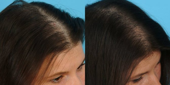 Мезотерапия для волос: до и после
