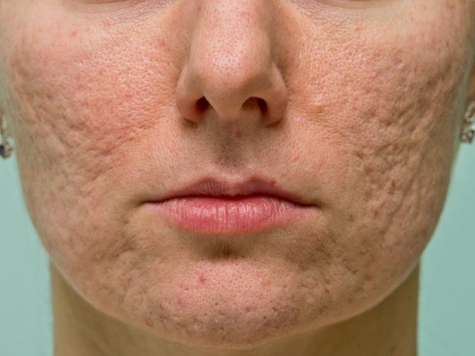 Неровная кожа лица – заметный косметический дефект, требующий устранения