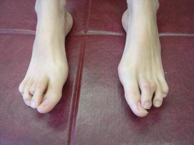 Пальцы ног, поражённые арахнодактилией