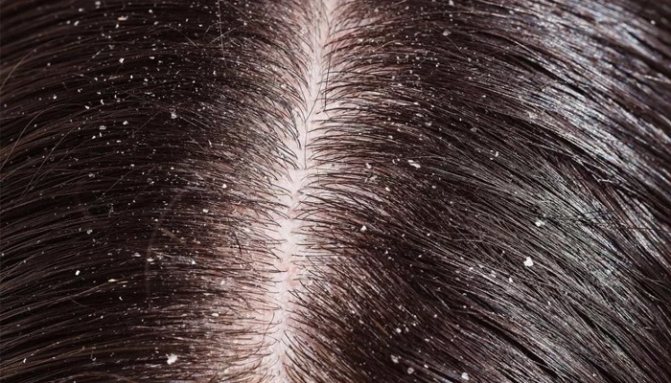 Перхоть и выпадение волос: причины, что делать, чем лечить