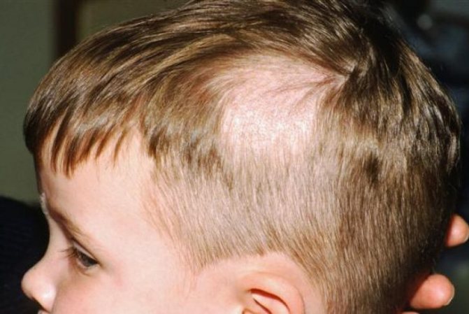 Почему выпадают волосы у ребенка