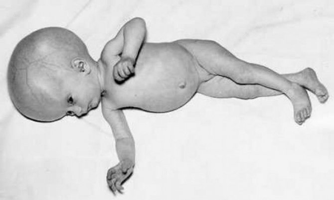 Последствия токсоплазмоза при беременности у ребенка