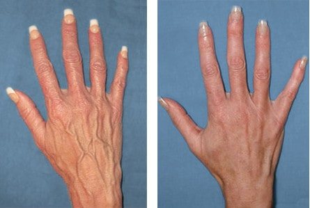 Расширенные вены на руках (до и после склерозирования)