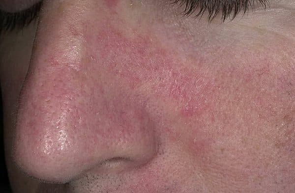Себорейный дерматит на лице: симптомы, диагностика, лечение и профилактика у взрослых
