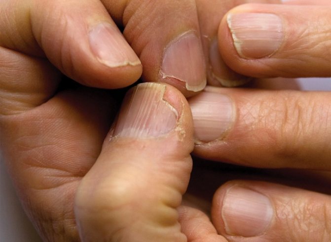 Симптомы грибка ногтей: ломкость и расслоение