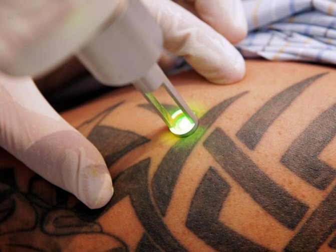 Снятие татуировки лазером