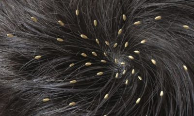 Сухие гниды на волосах: как отличить мертвые и живые, как убрать