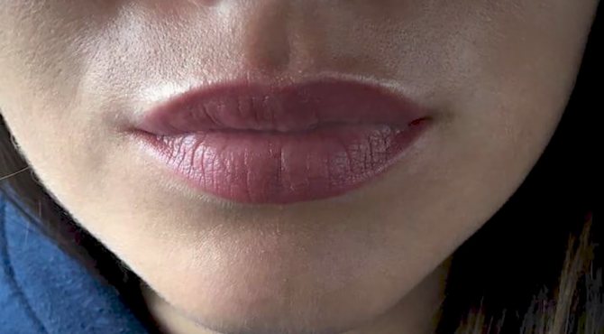 Удаление перманентного макияжа с губ ривайвинком