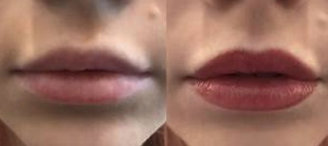 Удаление перманентного макияжа с губ