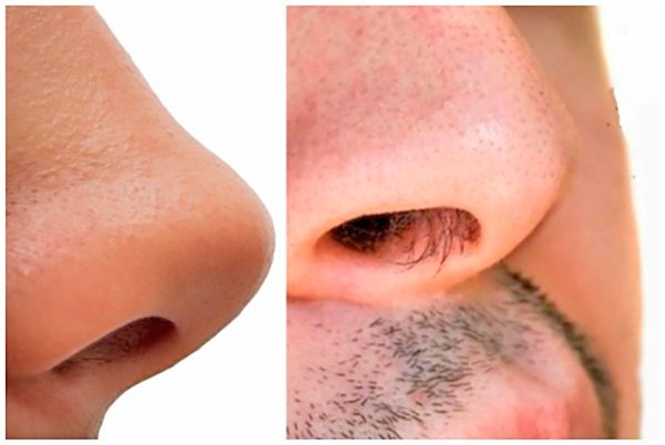 Удаление волос из носа - фото до и после