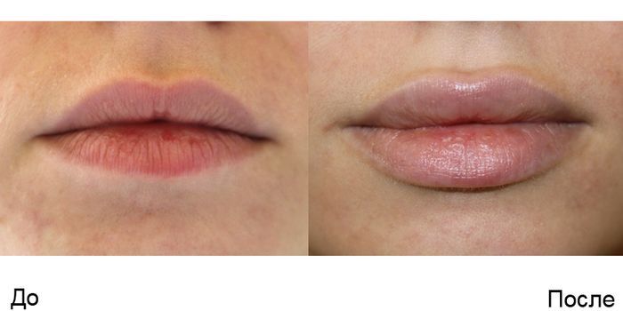 Увеличение губ гиалуроновой кислотой: до и после, фото