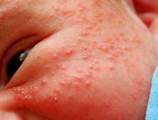 Виды аллергических высыпаний на коже у взрослых