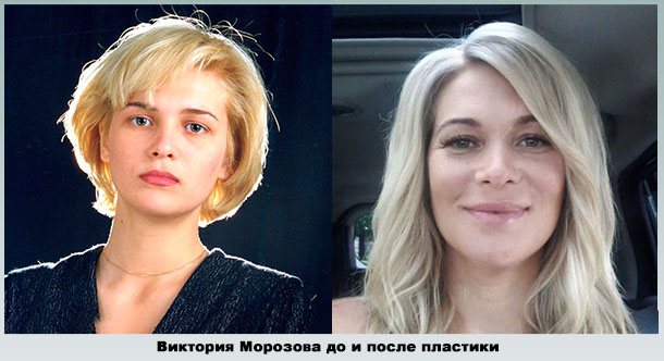 Виктория Макарская изменила форму губ